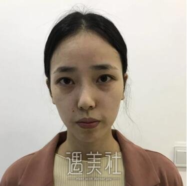 金孝宪,隆鼻