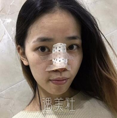 金孝宪,隆鼻