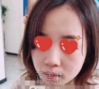 黄大勇隆鼻案例：害，谁不爱plmm呢 width=