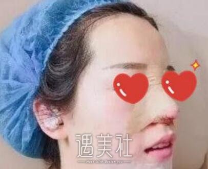 黄大勇,隆鼻
