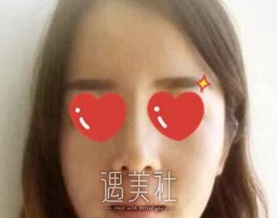 黄大勇,隆鼻