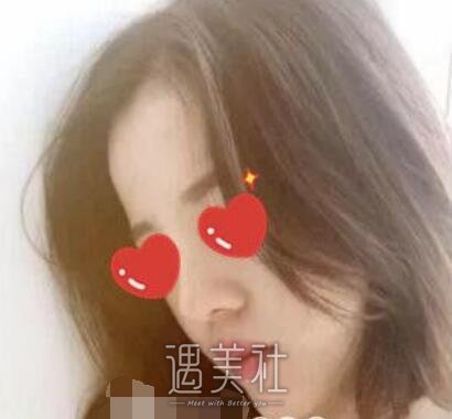 黄大勇,隆鼻