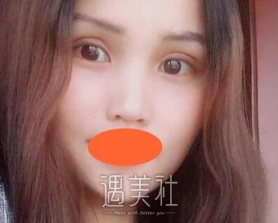 王国明,双眼皮