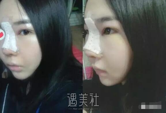 威海董立鹏整形医院怎么样?隆鼻案例及果图一览~