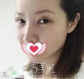 兰州陆军总院整形科双眼皮怎么样?案例及果图一览~