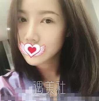 兰州陆军总院整形科双眼皮怎么样?案例及果图一览~