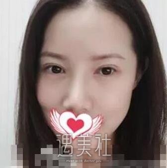 兰州陆军总院整形科双眼皮怎么样?案例及果图一览~