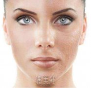 苏州祛痘坑痘印价格，什么因素影响价格? width=