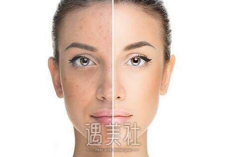 苏州祛痘坑痘印价格，什么因素影响价格?