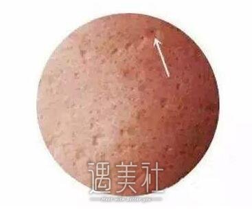 苏州祛痘坑痘印价格，什么因素影响价格?