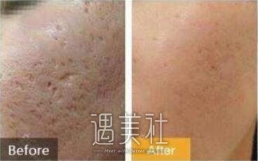苏州祛痘坑痘印价格，什么因素影响价格?