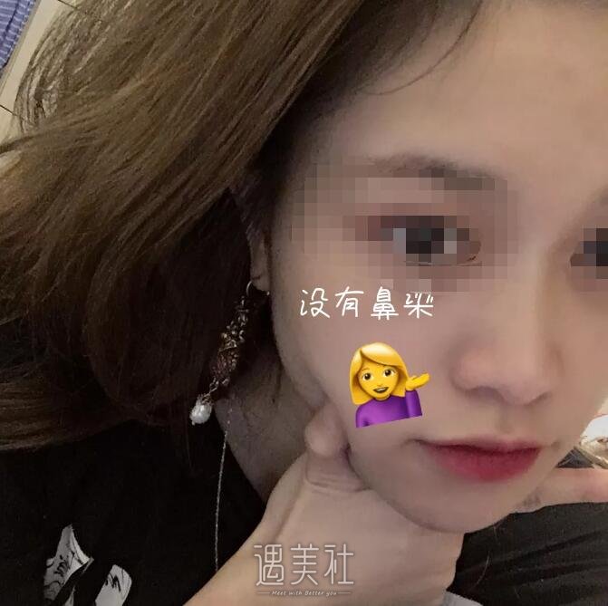 哈尔滨张宁整形医生的鼻部手术手术案例，还不错~