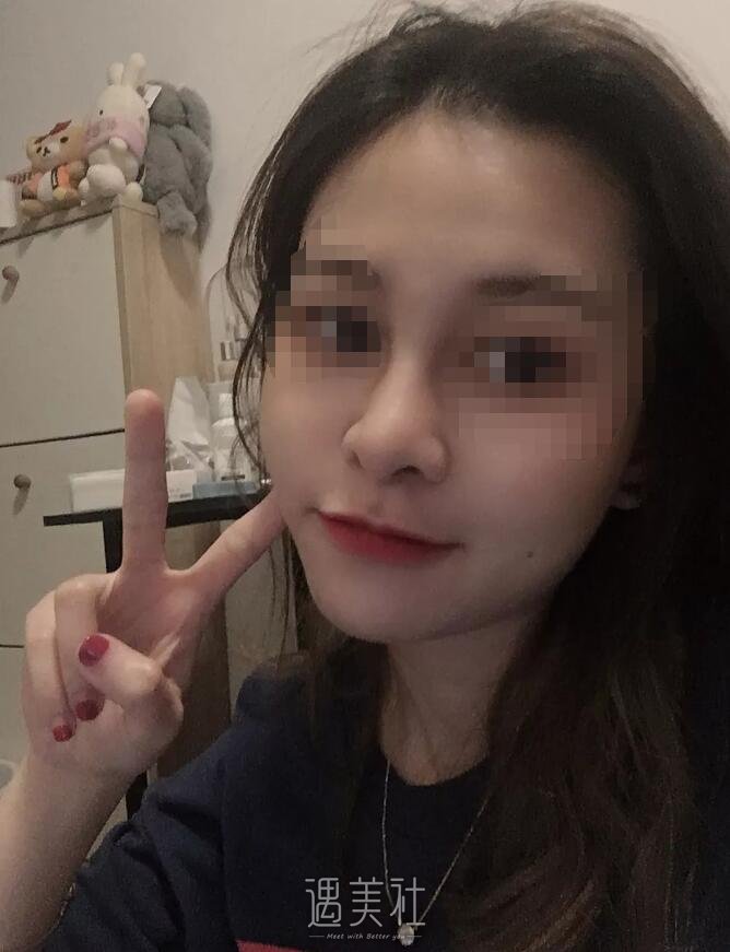 哈尔滨张宁整形医生的鼻部手术手术案例，还不错~