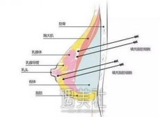 硅胶隆胸后应该注意哪些事项？术后要怎么护理？ width=