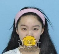 九院周惠芳双眼皮案例：这双明媚电眼谁看了不心动？ width=