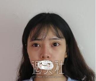 张正文,隆鼻