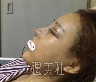 张正文,隆鼻