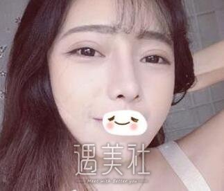 张正文,隆鼻