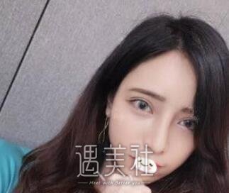 张正文,隆鼻