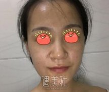 李斌斌隆鼻案例：再也不用活的小心翼翼 width=
