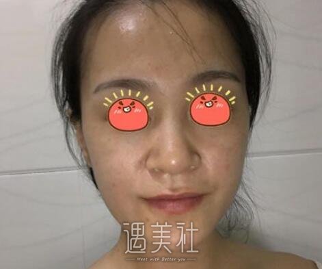 李斌斌,隆鼻