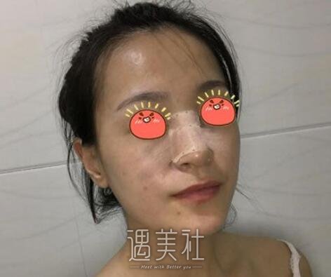 李斌斌,隆鼻