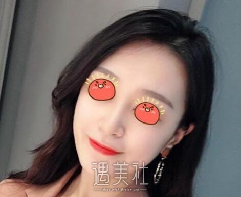 李斌斌,隆鼻