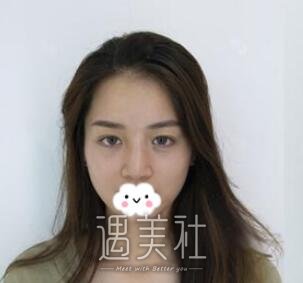 李庭勋,隆鼻