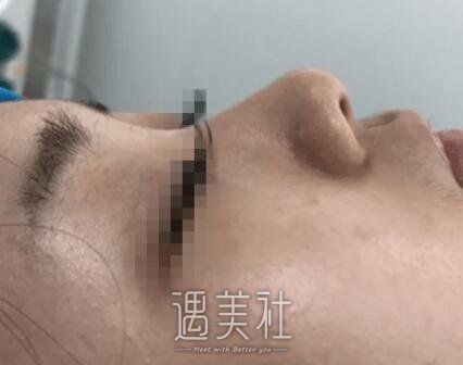 金海坤,隆鼻