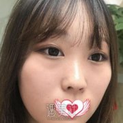 曹海峰隆鼻案例 术后成了翘鼻女神 width=
