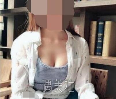 李朕,脂肪丰胸