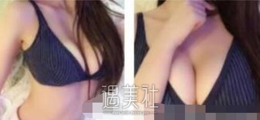 栗勇,丰胸