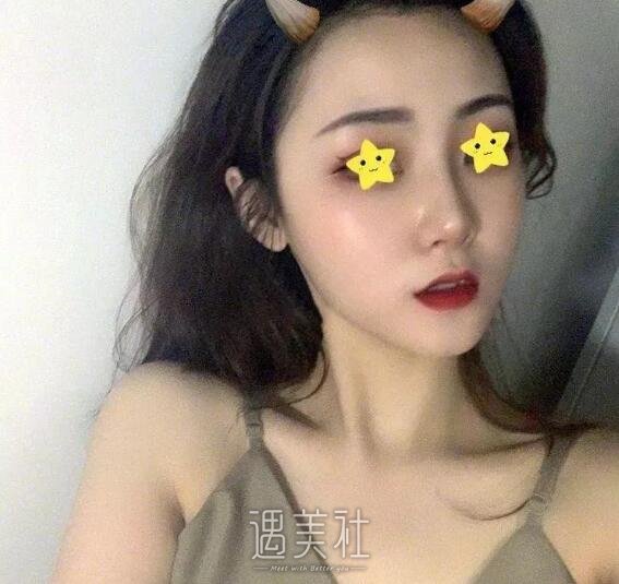 王珍祥做鼻子怎么样|王珍祥隆鼻案例硬核证明!