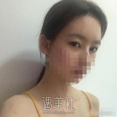 唐都医院整形科李望舟技术如何?双眼皮案例一览~