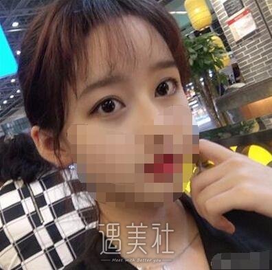 唐都医院整形科李望舟技术如何?双眼皮案例一览~