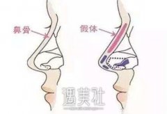 假体隆鼻的风险都有什么？术后会不会有什么危害？ width=