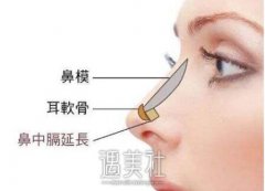 假体隆鼻有没有危险呢？风险体现在哪里？ width=