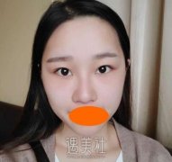 九院孙静双眼皮案例：肿泡眼蜕变为魅力大眼的过程~ width=