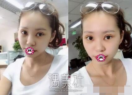 杨明勇,双眼皮