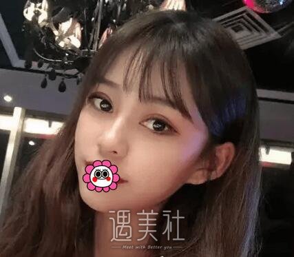 杨明勇,双眼皮