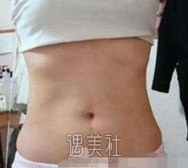 腰腹环吸