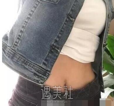 腰腹环吸
