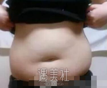 腰腹环吸