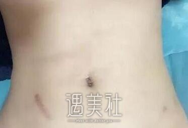 腰腹环吸