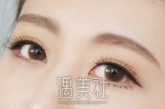 北京做眼睑下垂矫正多少钱？主要和这些因素有关？ width=