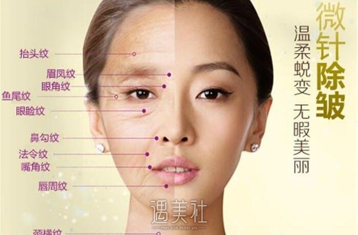 微针多少钱一次?收费标准是如何定夺?