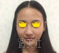 面部提升针打的是什么？注射瘦脸案例+前后对比图一览~ width=