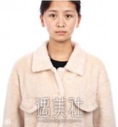 广州曙光做双眼皮好吗？看看案例就知道了 width=