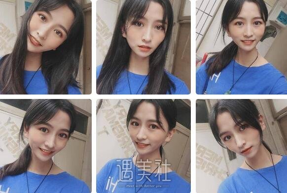 广州,曙光,双眼皮