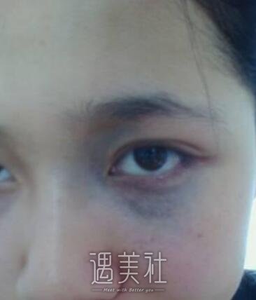 太田痣调节